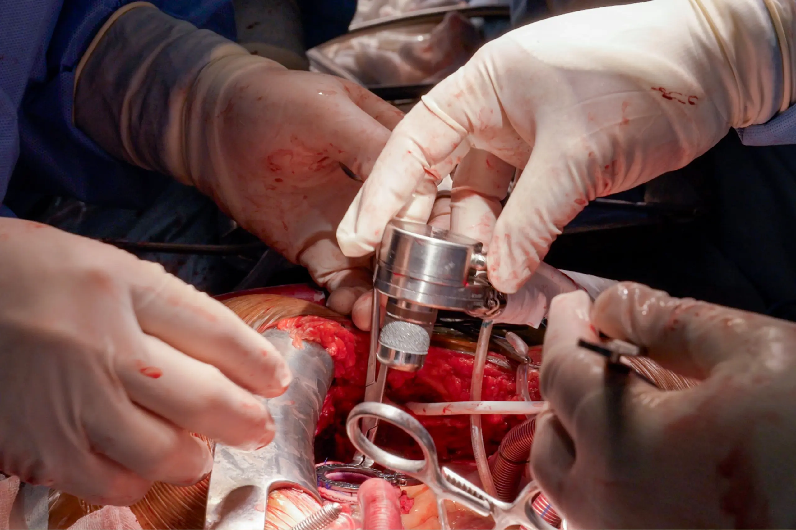 6 LVAD Implantation Surgery